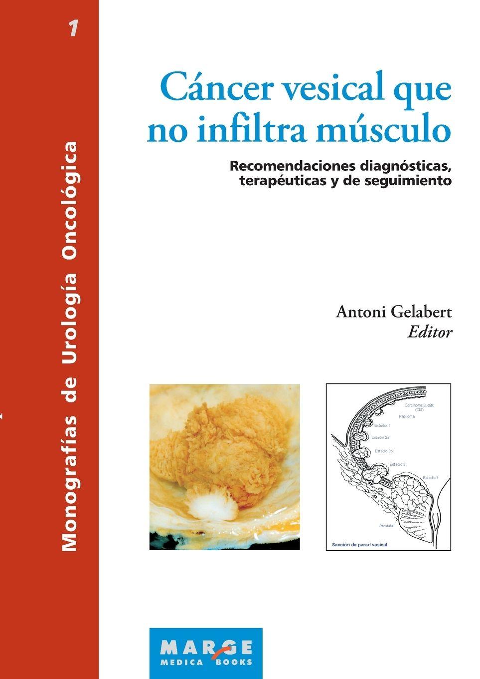 Vorderes Coverbild Cáncer vesical que no infiltra músculo