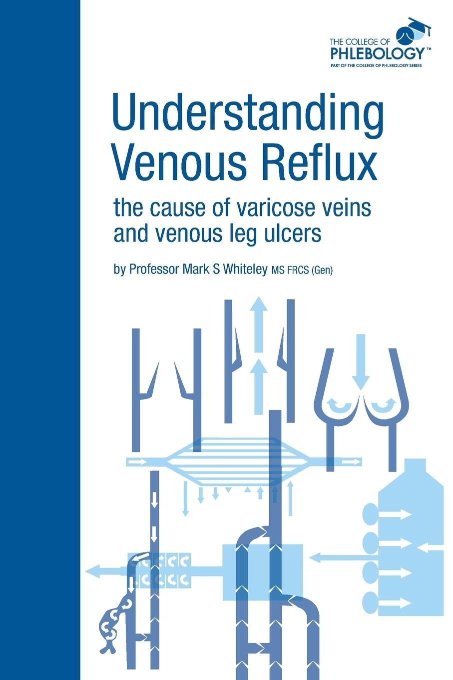 Vorderes Coverbild Understanding Venous Reflux the Cause of Varicose Veins and Venous Leg Ulcers