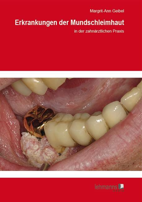 Vorderes Coverbild Erkrankungen der Mundschleimhaut