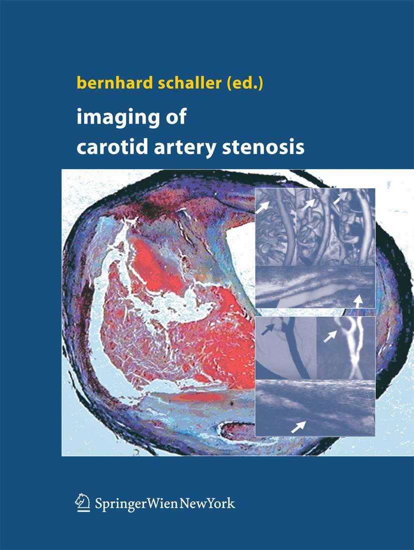 Vorderes Coverbild Imaging of Carotid Artery Stenosis
