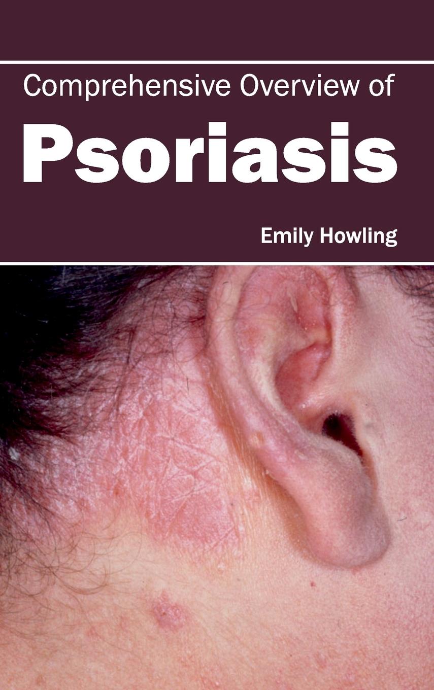 Vorderes Coverbild Comprehensive Overview of Psoriasis
