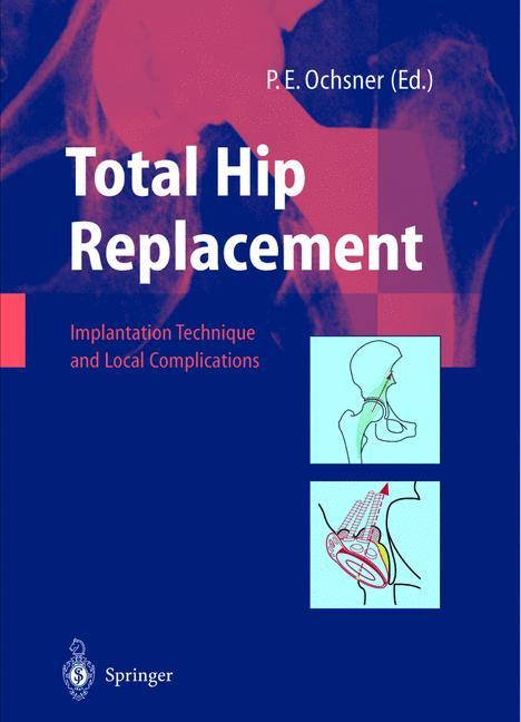 Vorderes Coverbild Total Hip Replacement
