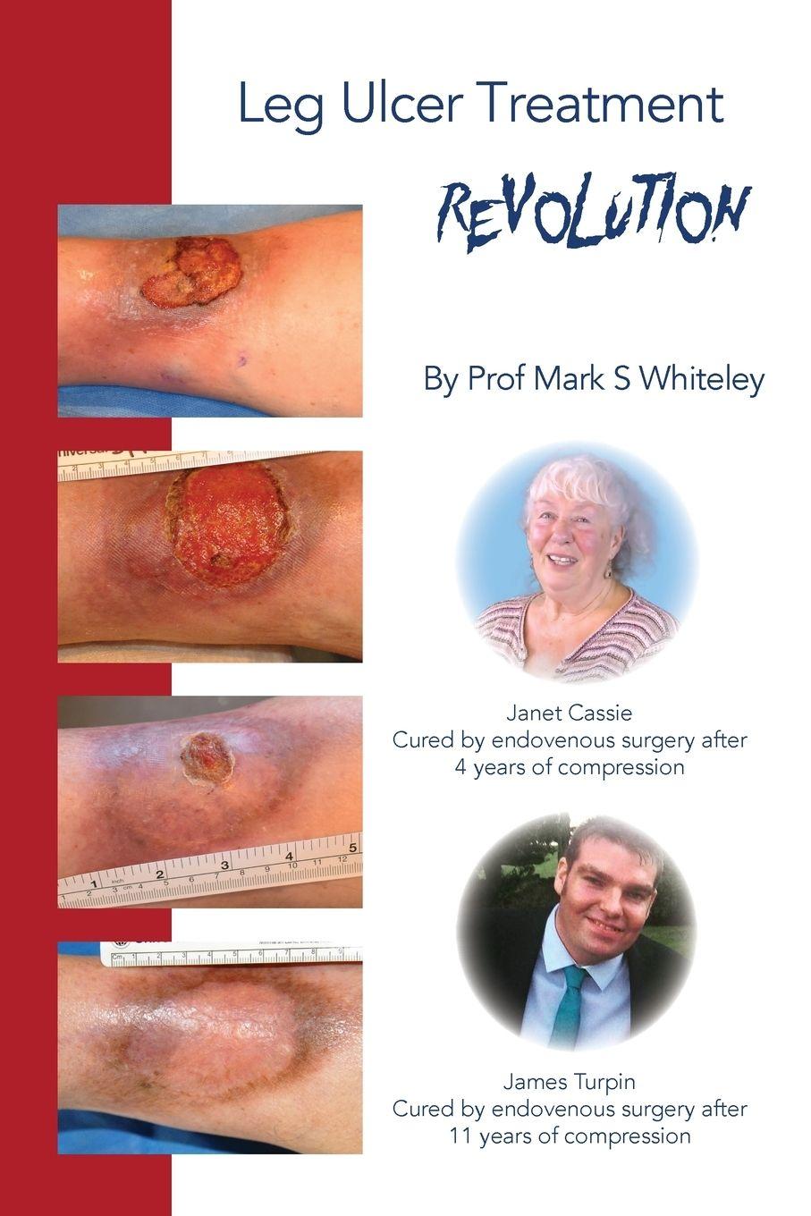 Vorderes Coverbild Leg Ulcer Treatment Revolution