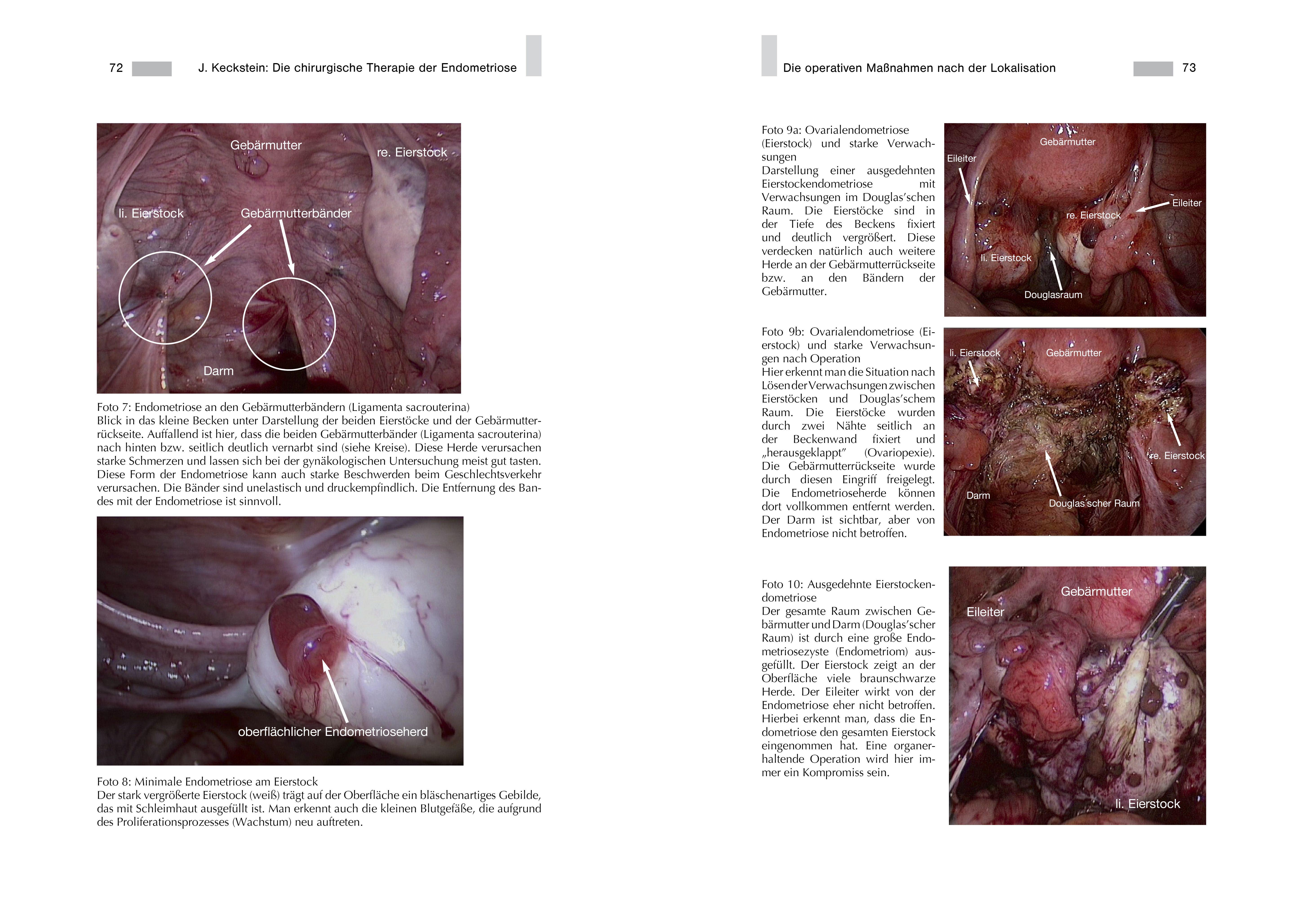 Beispielinhalt (Bild) Endometriose - Die verkannte Frauenkrankheit