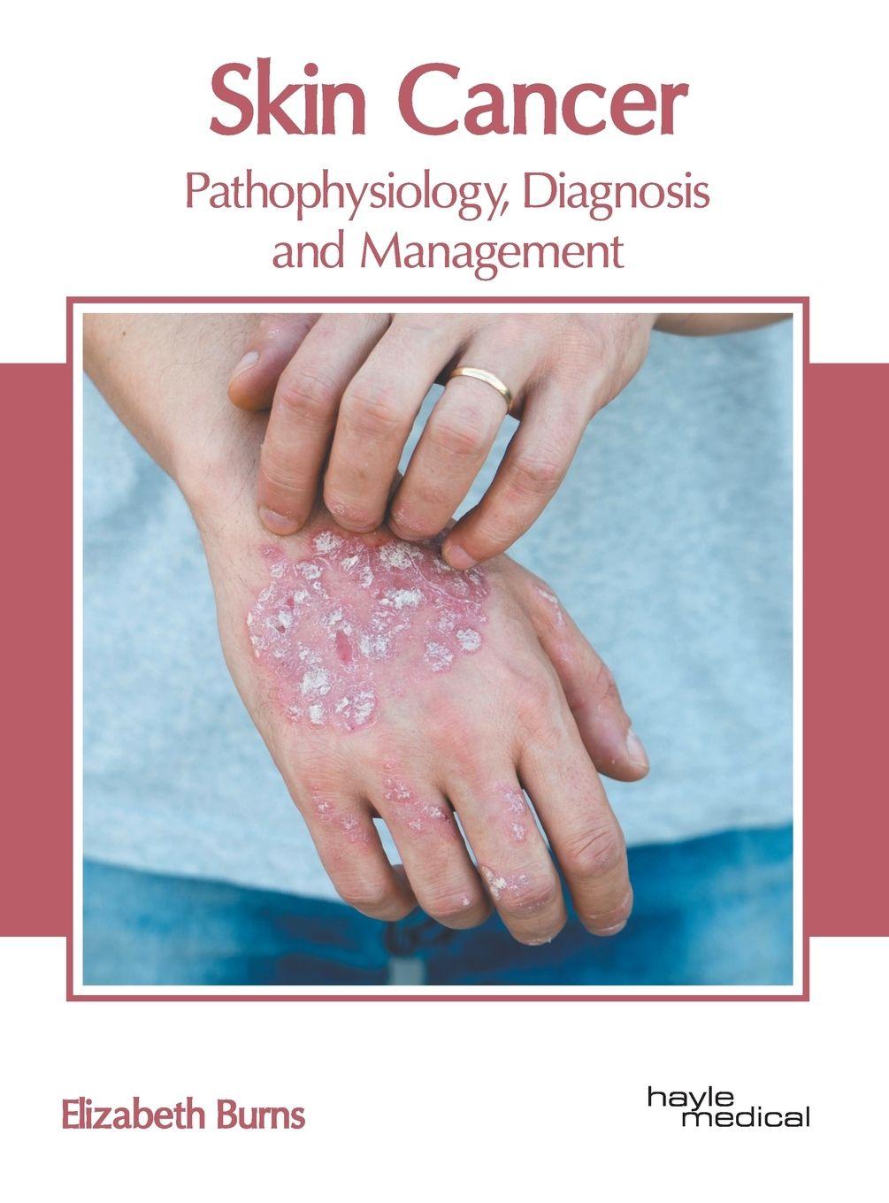 Vorderes Coverbild Skin Cancer: Pathophysiology, Diagnosis and Management