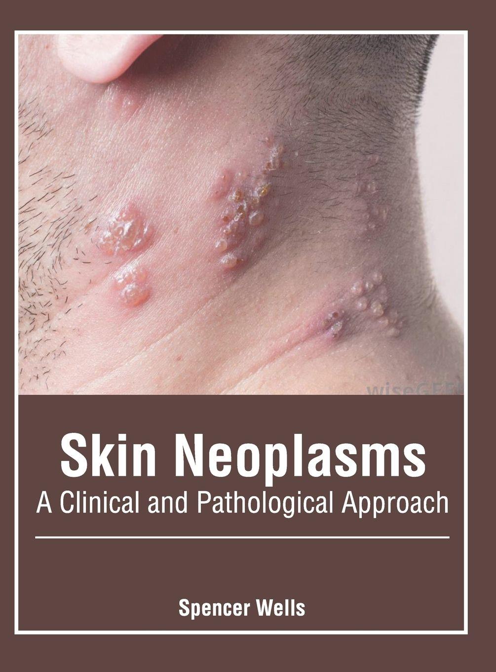 Vorderes Coverbild Skin Neoplasms: A Clinical and Pathological Approach