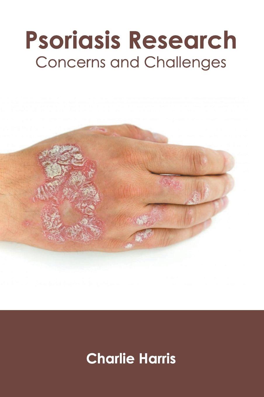 Vorderes Coverbild Psoriasis Research: Concerns and Challenges