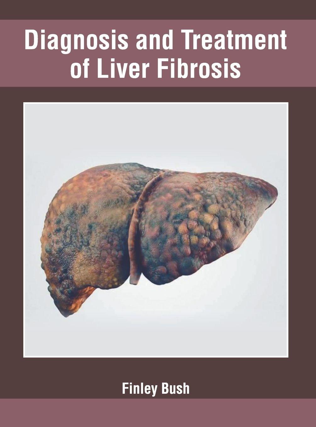 Vorderes Coverbild Diagnosis and Treatment of Liver Fibrosis