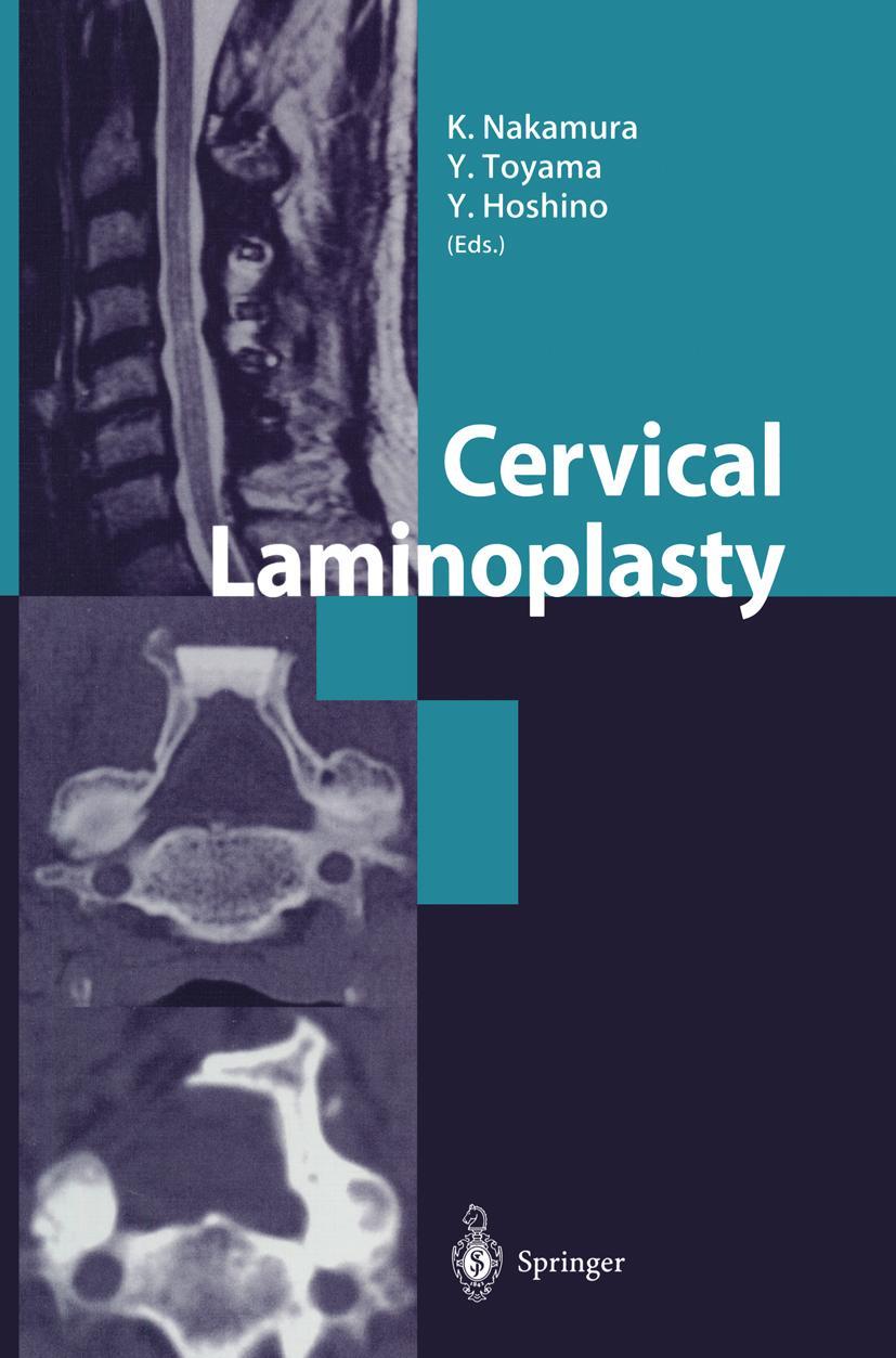 Vorderes Coverbild Cervical Laminoplasty