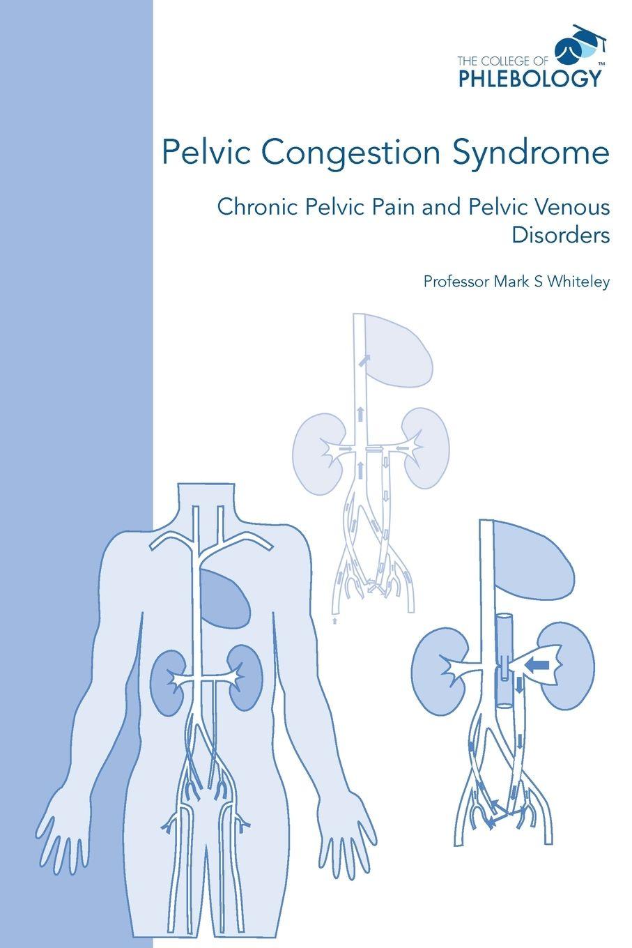 Vorderes Coverbild Pelvic Congestion Syndrome - Chronic Pelvic Pain and Pelvic Venous Disorders