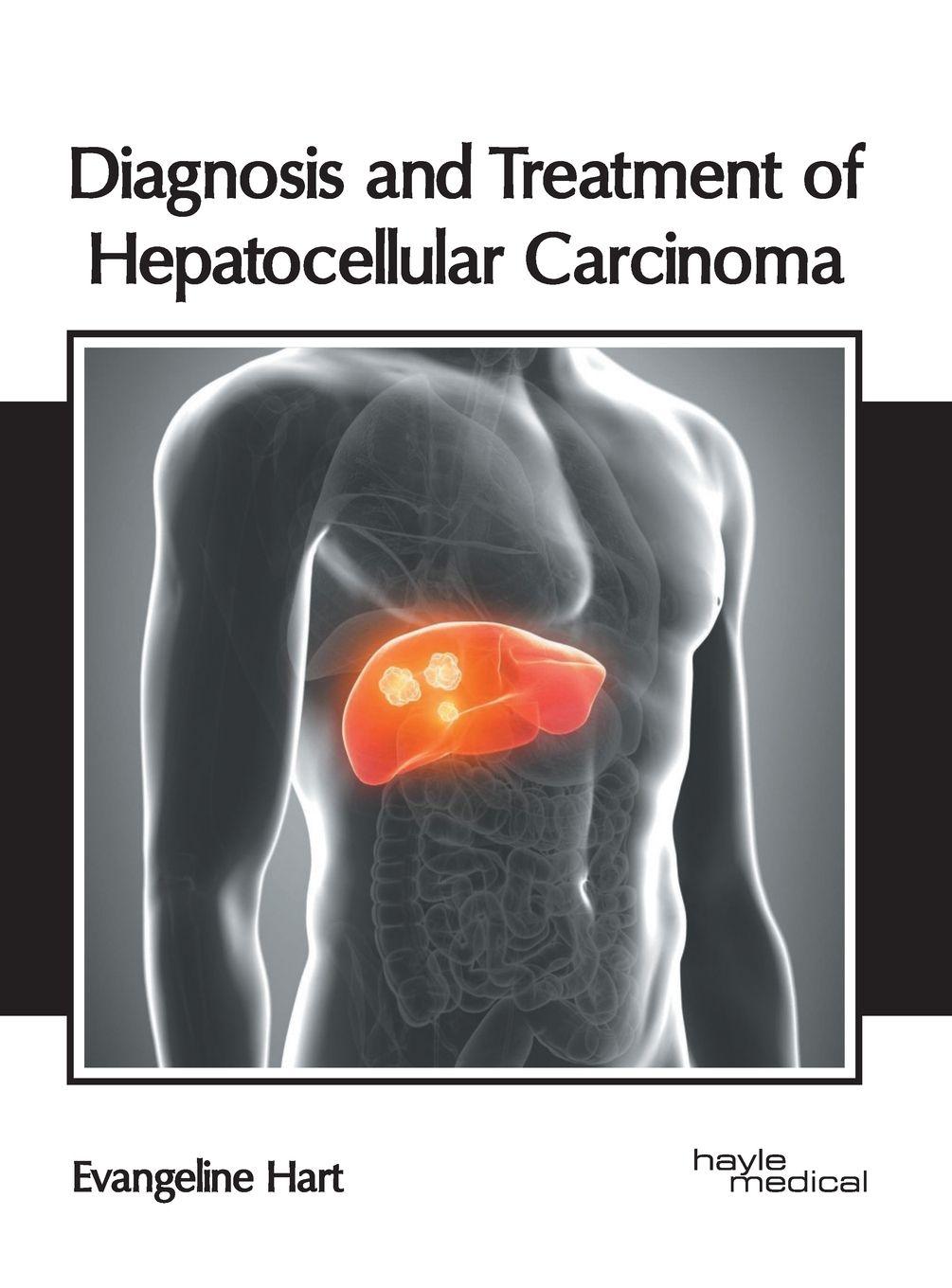 Vorderes Coverbild Diagnosis and Treatment of Hepatocellular Carcinoma