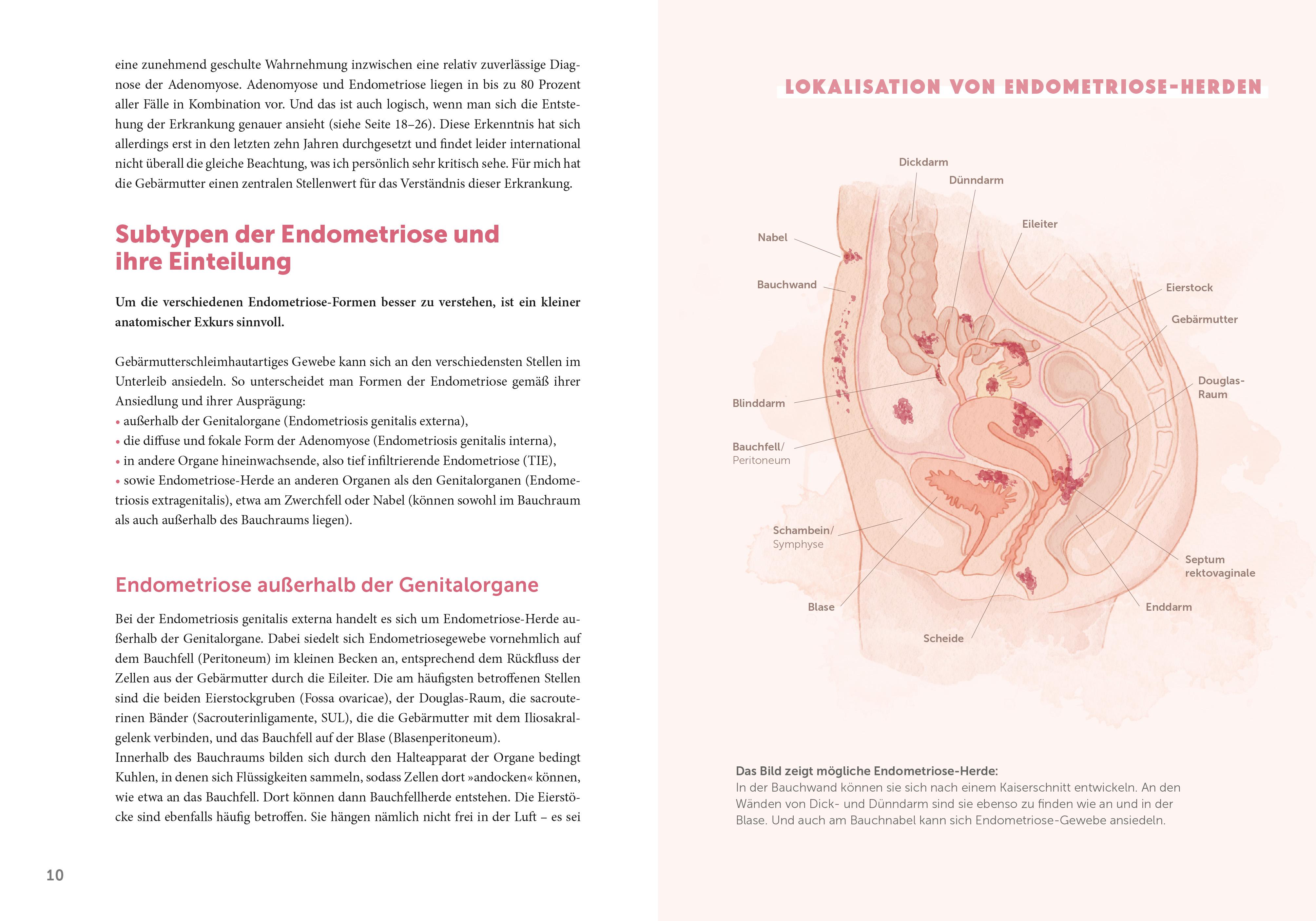 Beispielinhalt (Bild) Endometriose - Die unterschätzte Krankheit