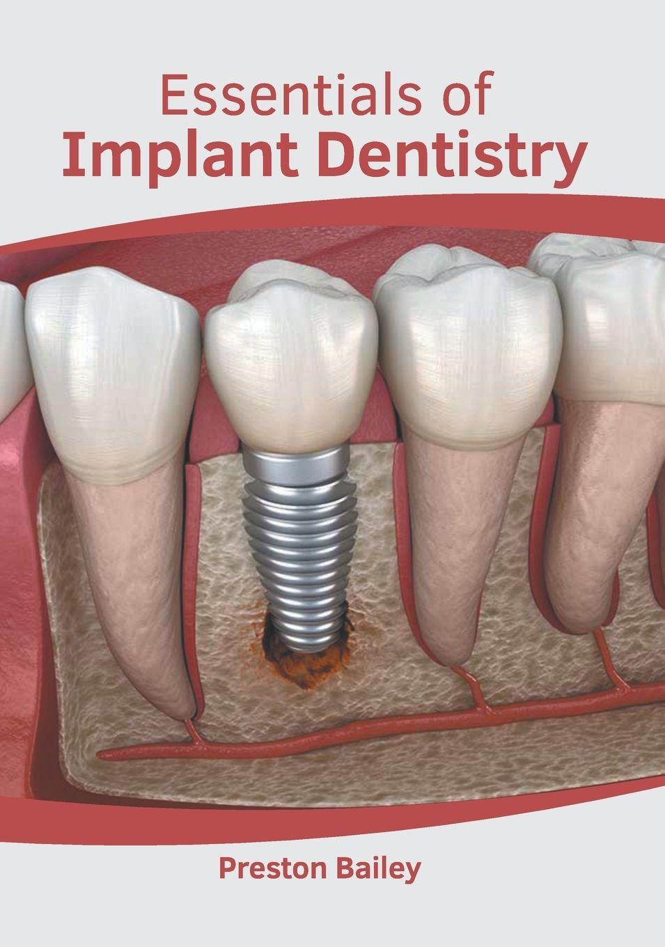Vorderes Coverbild Essentials of Implant Dentistry