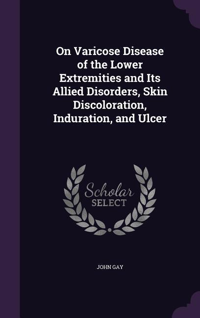 Vorderes Coverbild On Varicose Disease of the Lower Extremities and Its Allied Disorders, Skin Discoloration, Induration, and Ulcer
