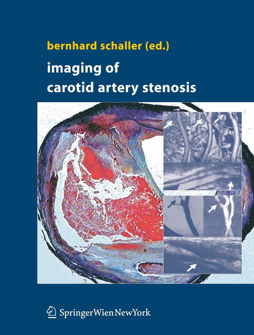 Vorderes Coverbild Imaging of Carotid Artery Stenosis