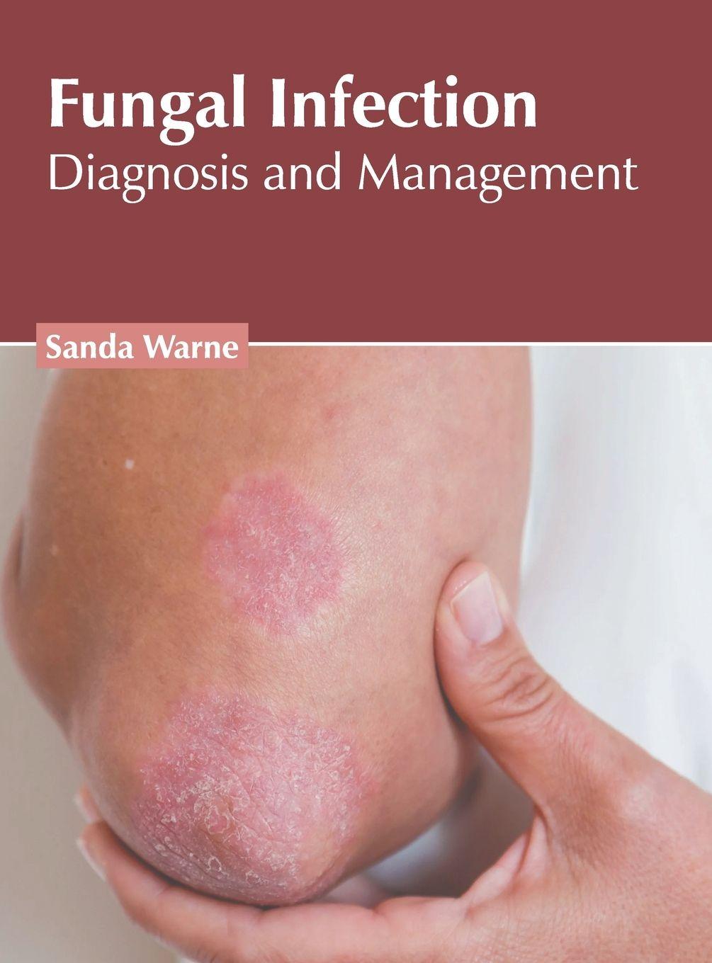 Vorderes Coverbild Fungal Infection: Diagnosis and Management