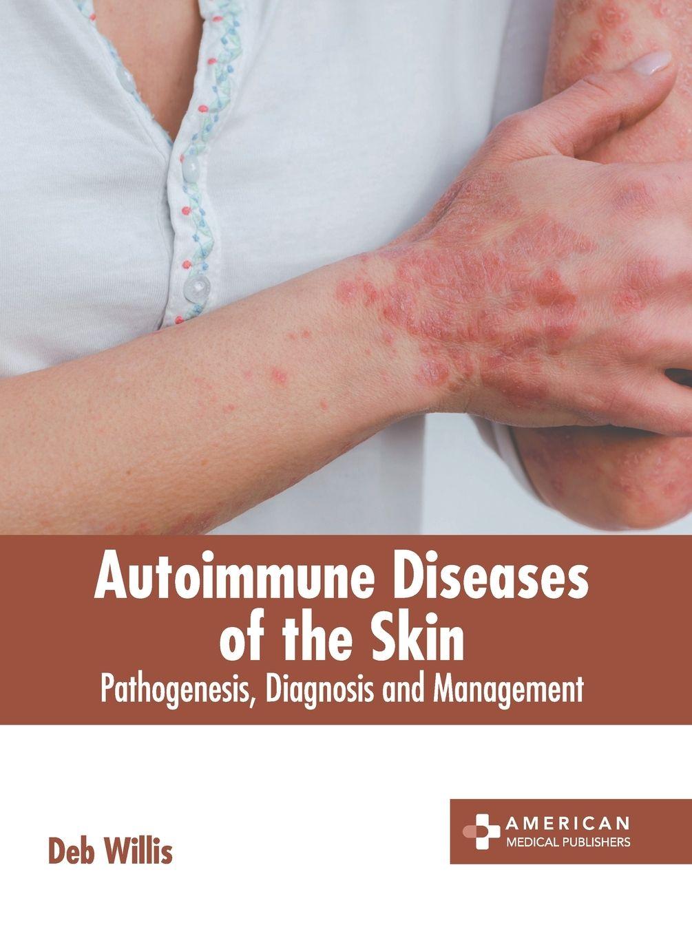 Vorderes Coverbild Autoimmune Diseases of the Skin: Pathogenesis, Diagnosis and Management