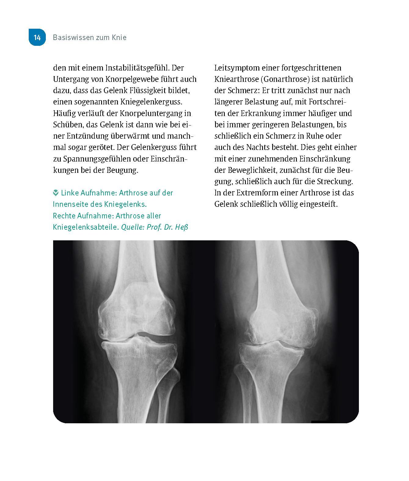 Beispielinhalt (Bild) Schmerzfrei & beweglich mit dem neuen Kniegelenk