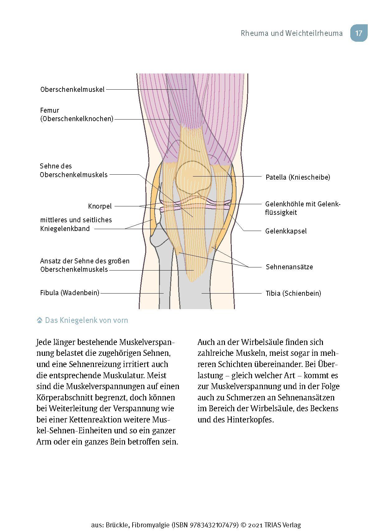 Beispielinhalt (Bild) Fibromyalgie