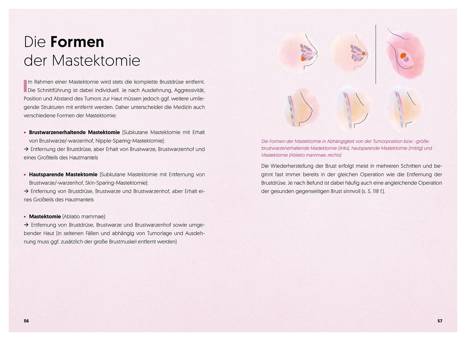 Beispielinhalt (Bild) Diagnose Brustkrebs