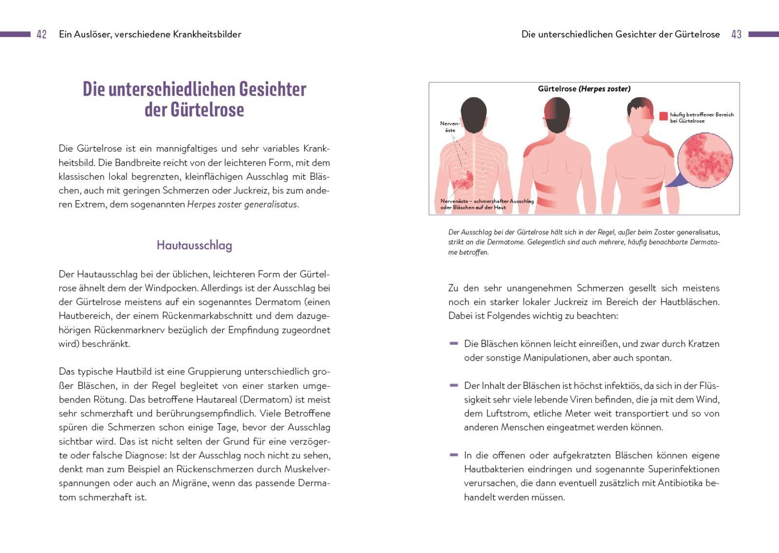 Beispielinhalt (Bild) Gürtelrose