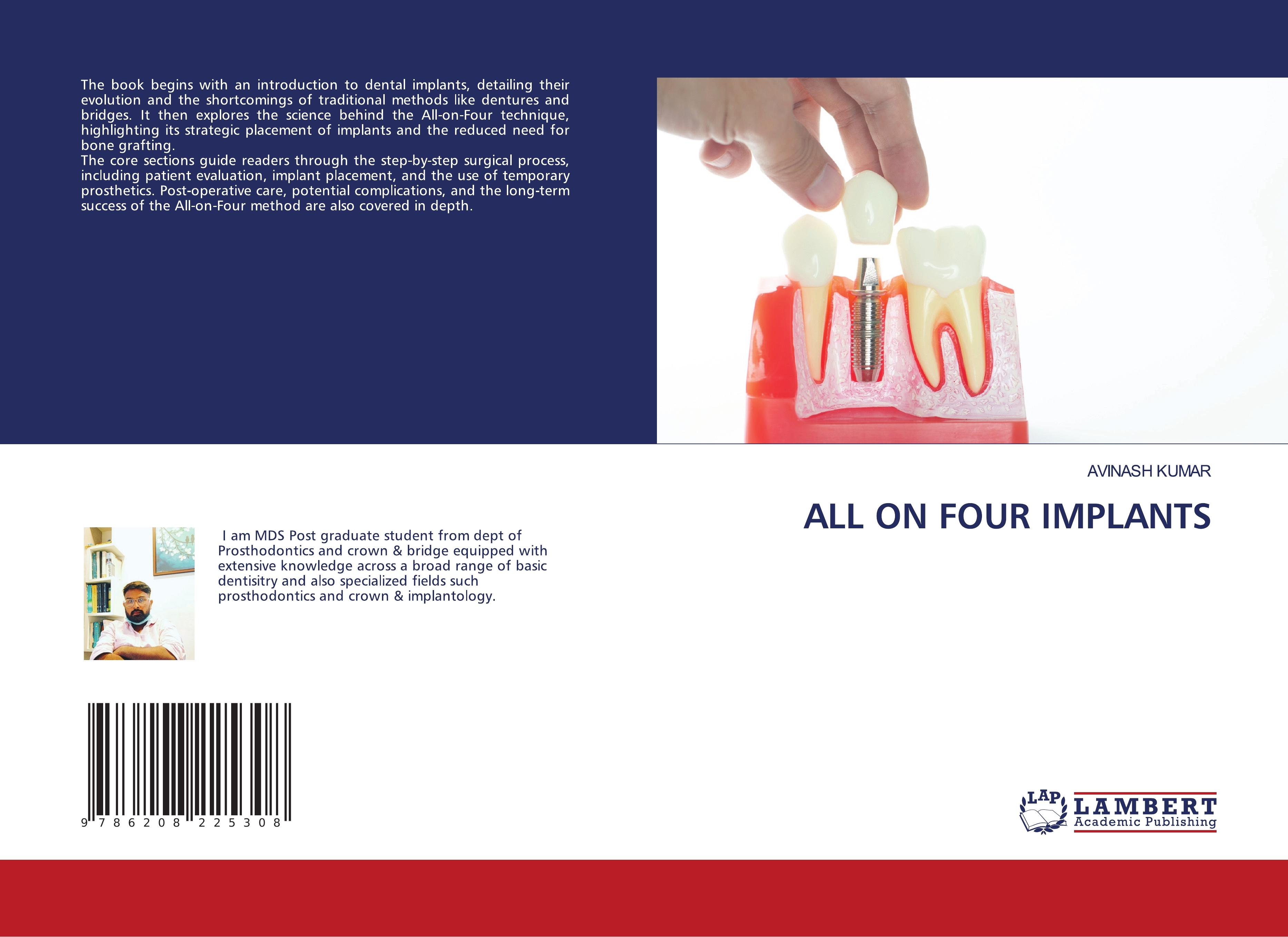 Vorderes Coverbild ALL ON FOUR IMPLANTS