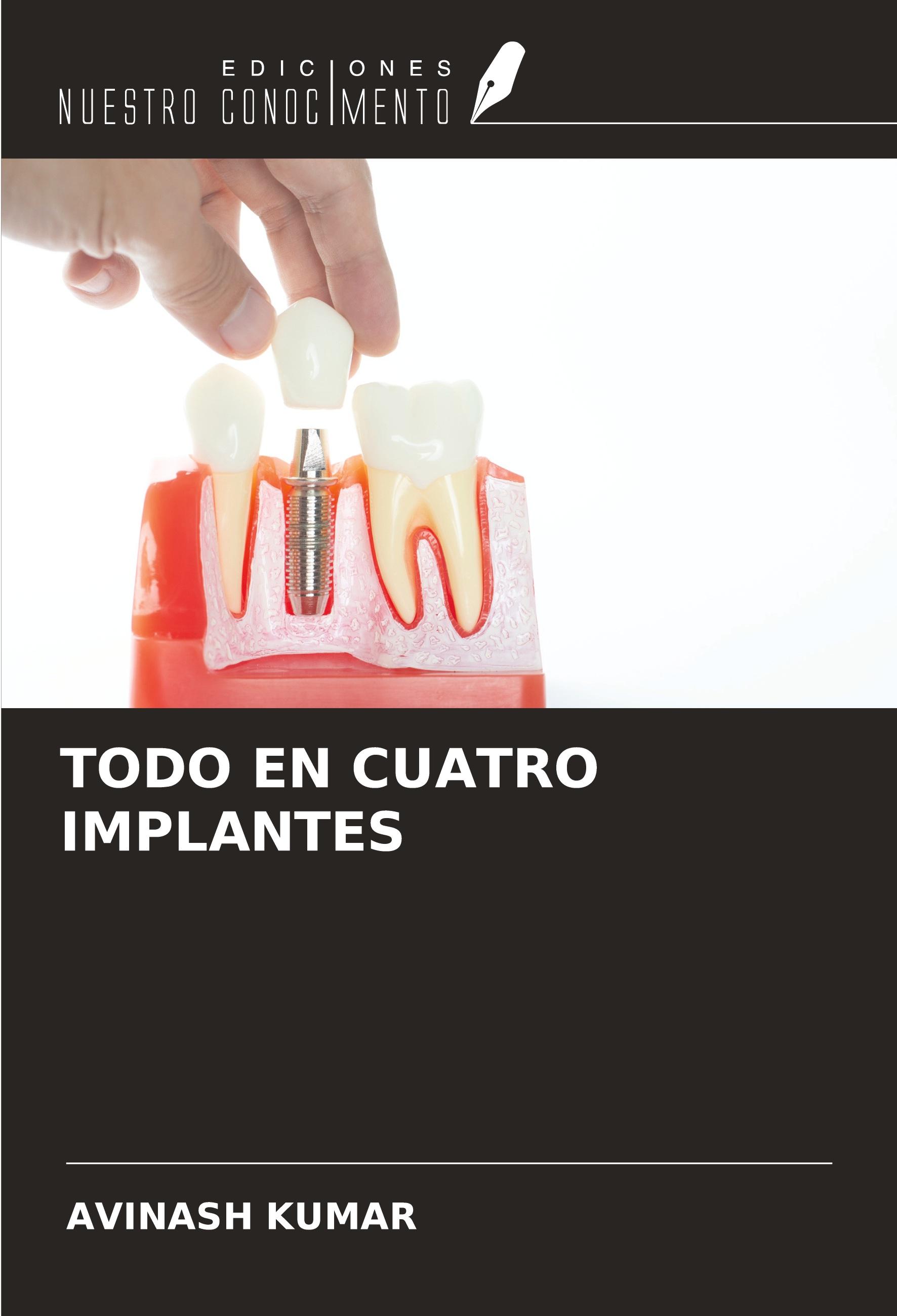Vorderes Coverbild TODO EN CUATRO IMPLANTES