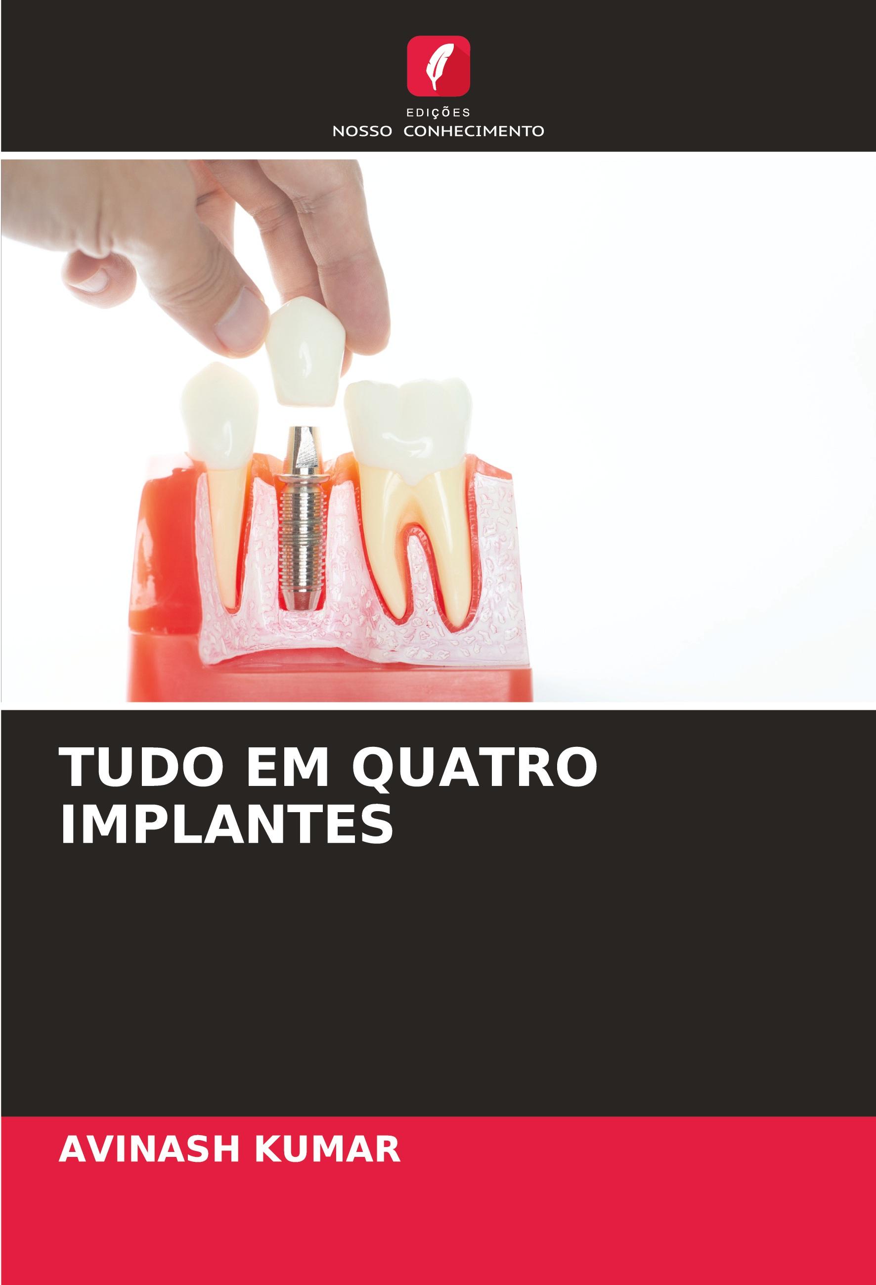 Vorderes Coverbild TUDO EM QUATRO IMPLANTES
