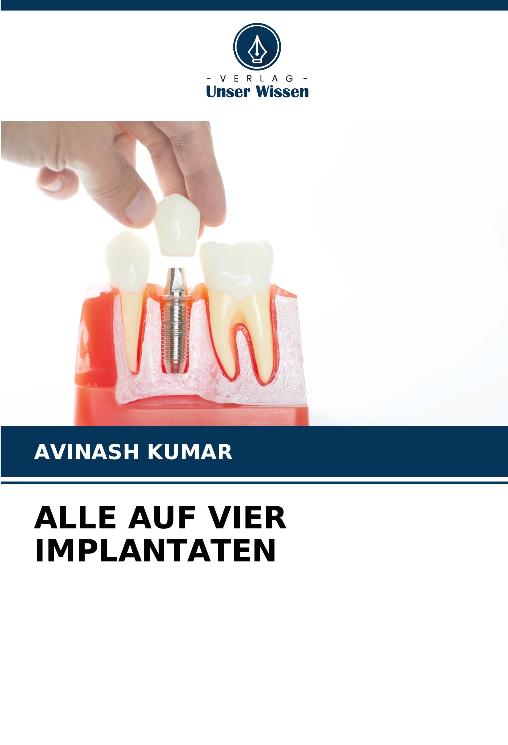 Vorderes Coverbild ALLE AUF VIER IMPLANTATEN