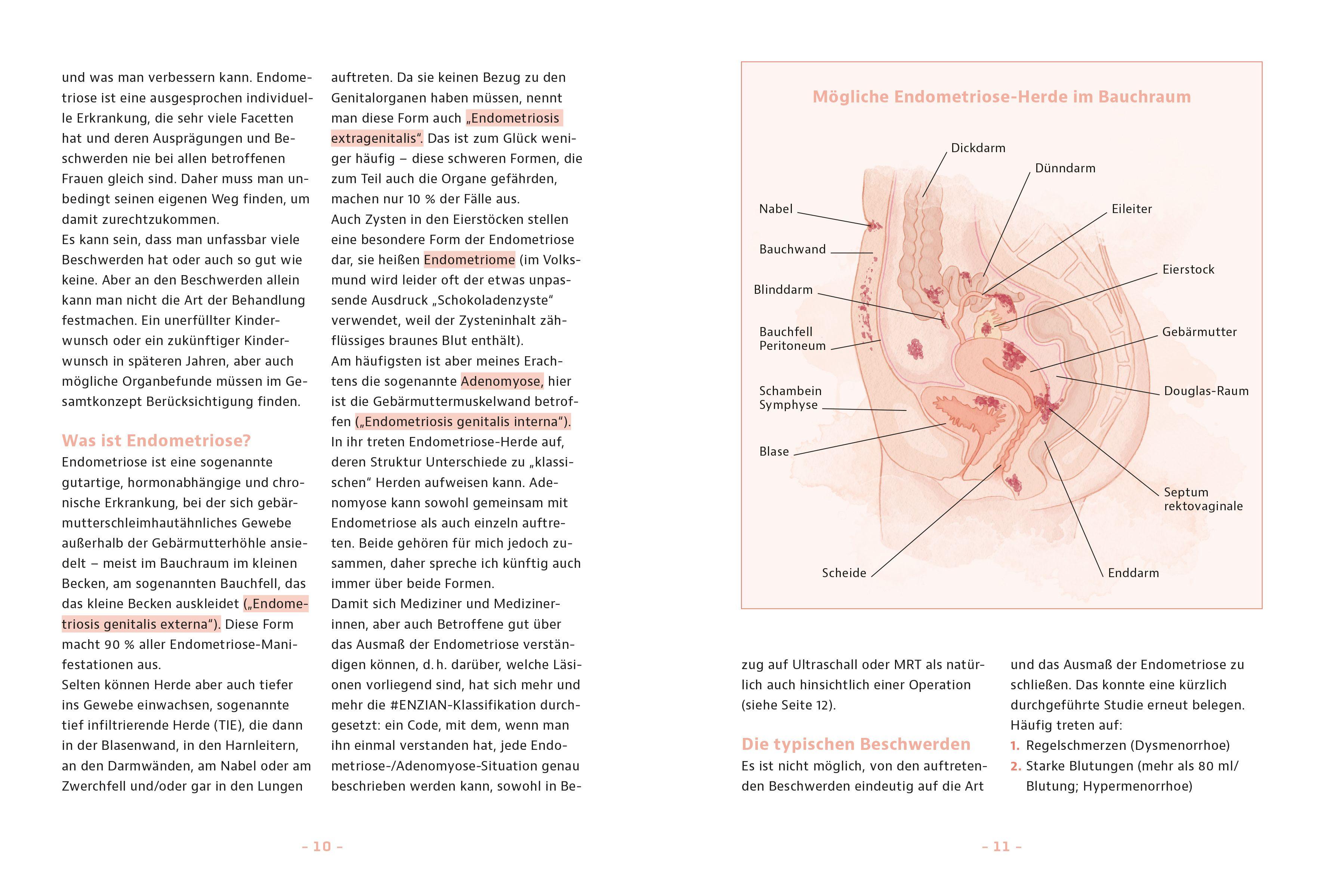 Beispielinhalt (Bild) Endometriose - was tun?