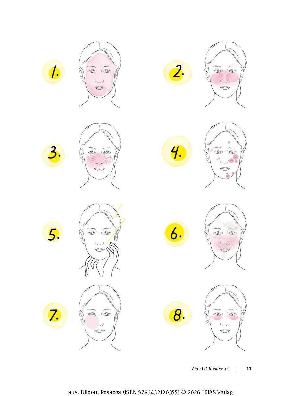 Beispielinhalt (Bild) Rosacea