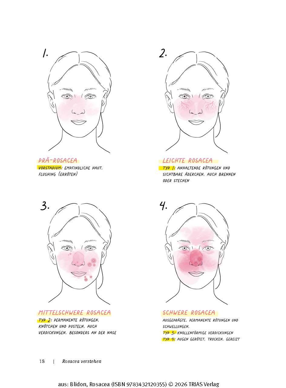 Beispielinhalt (Bild) Rosacea