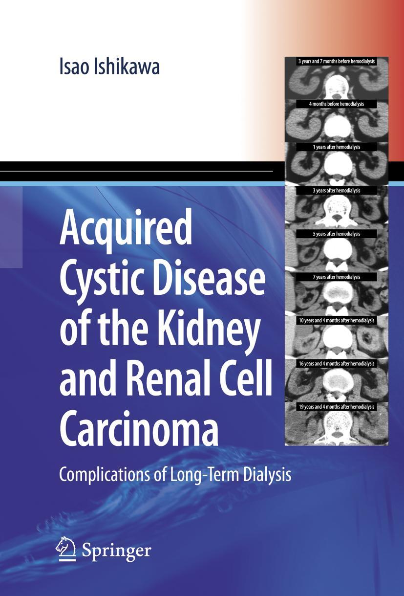 Vorderes Coverbild Acquired Cystic Disease of the Kidney and Renal Cell Carcinoma