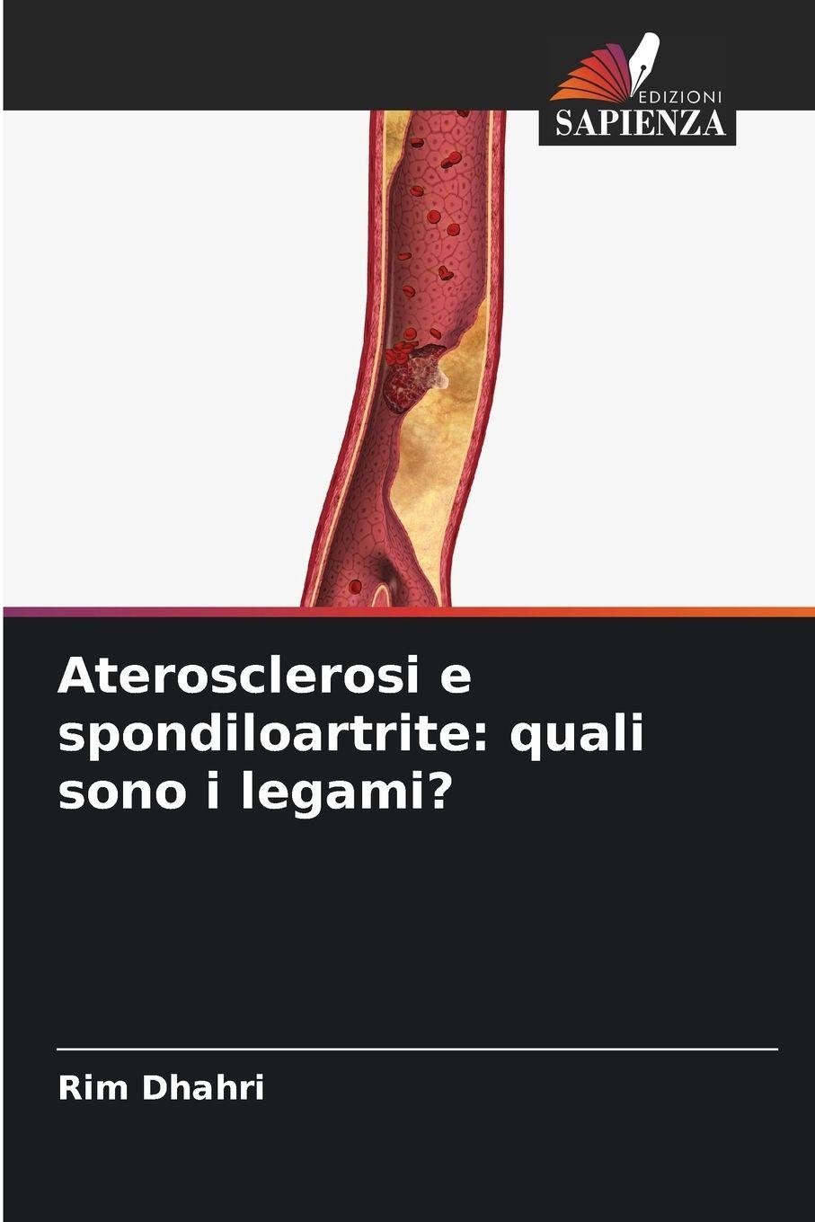 Vorderes Coverbild Aterosclerosi e spondiloartrite: quali sono i legami?