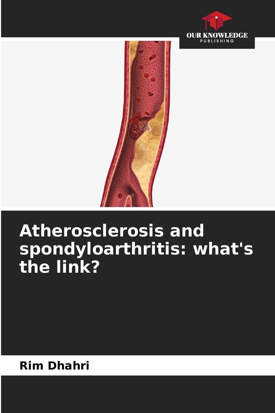 Vorderes Coverbild Atherosclerosis and spondyloarthritis: what's the link?