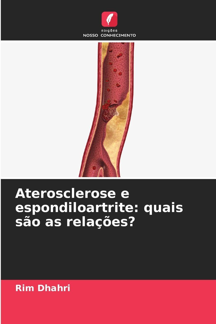 Vorderes Coverbild Aterosclerose e espondiloartrite: quais são as relações?