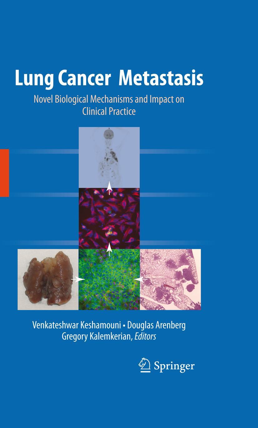 Vorderes Coverbild Lung Cancer Metastasis