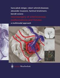 Vorderes Coverbild Neurosurgery of Arteriovenous Malformations and Fistulas
