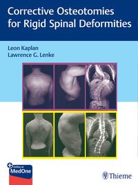 Vorderes Coverbild Corrective Osteotomies for Rigid Spinal Deformities