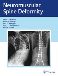 Vorderes Coverbild Neuromuscular Spine Deformity