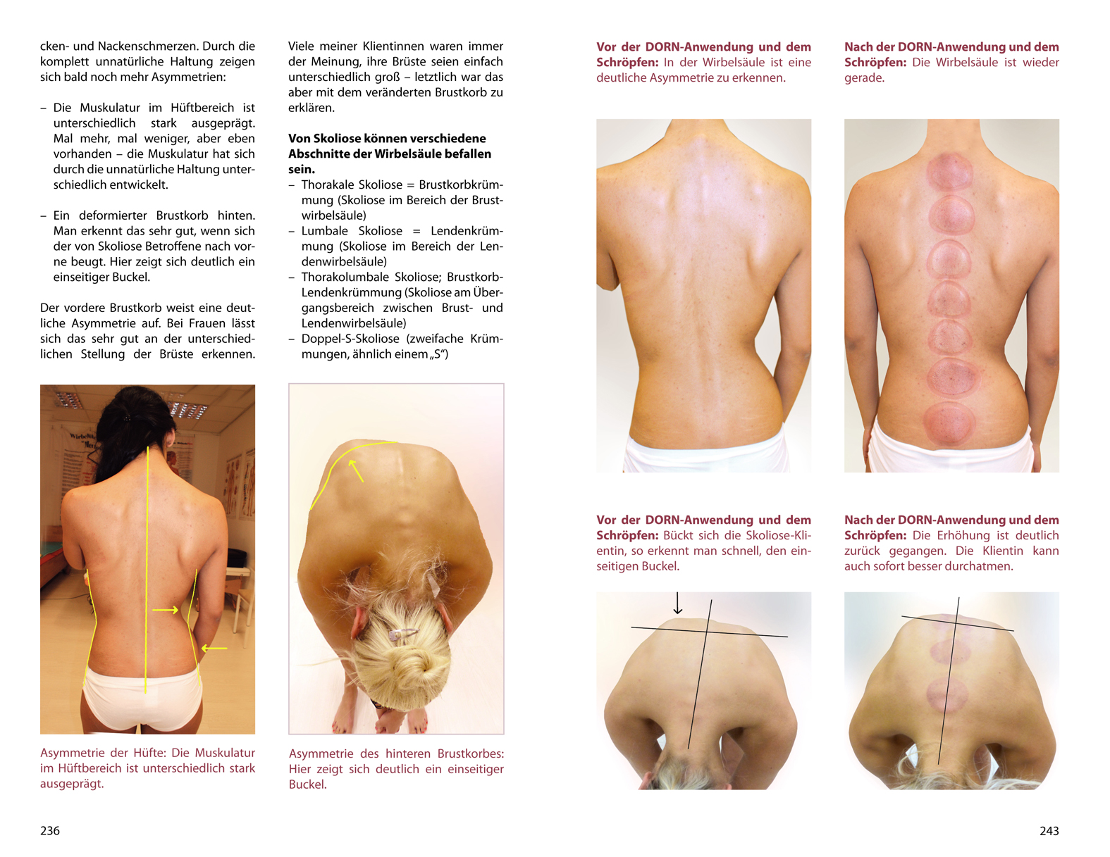 Beispielinhalt (Bild) Schröpfen und Gua Sha