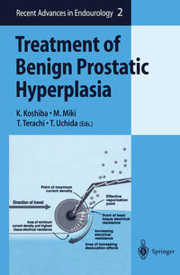 Vorderes Coverbild Treatment of Benign Prostatic Hyperplasia