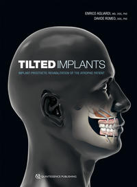 Vorderes Coverbild Tilted Implants