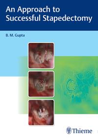 Vorderes Coverbild An Approach to Successful Stapedectomy